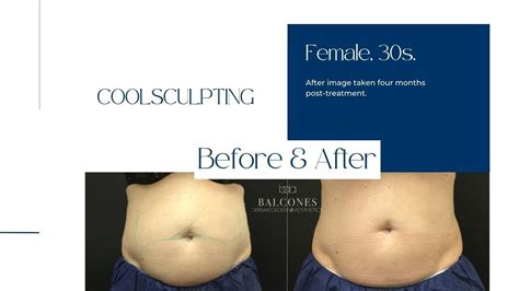 sarnia coolsculpting|About .